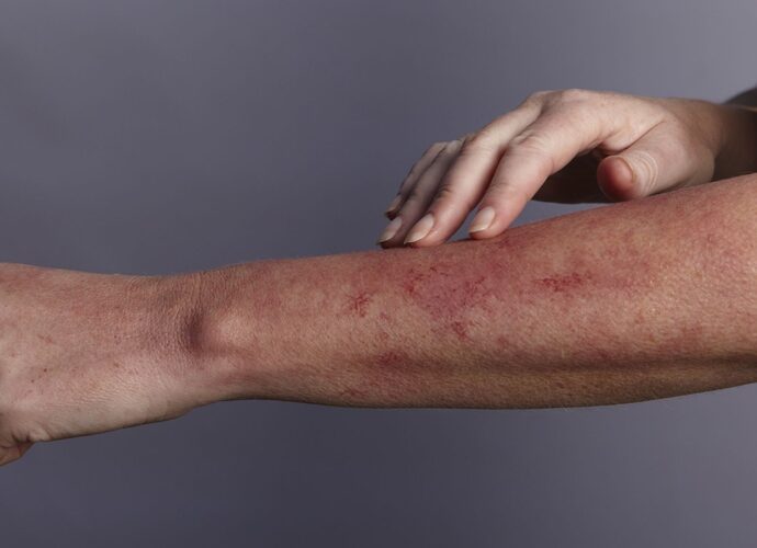 Wajib Tahu:Tips Hidup Sehat untuk Penderita Lupus