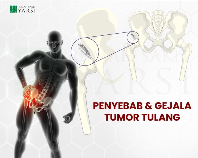 Wajib Tahu, Penyebab dan Gejala Tumor Tulang