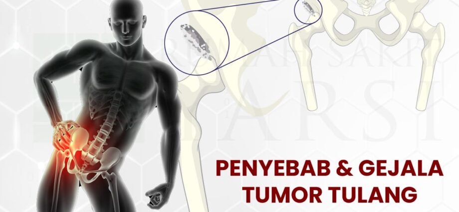 Wajib Tahu, Penyebab dan Gejala Tumor Tulang